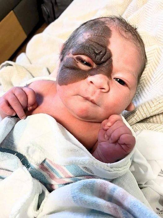 P3. Mom wants to show 13-month-old daughter with rare birthmark that she is beautiful